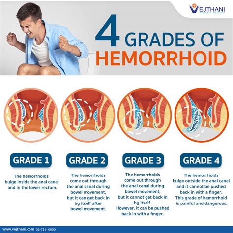 There are things you can do to treat and prevent piles. . Do guys care about hemorrhoids